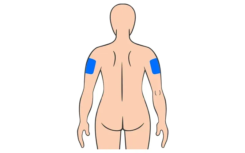Back of the upper arm subcutaneous injection sites, shown from behind